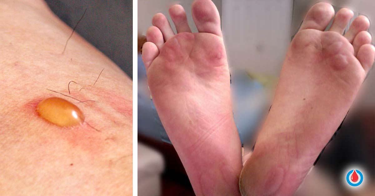 blisters-benenati-foot-and-ankle-care-centers