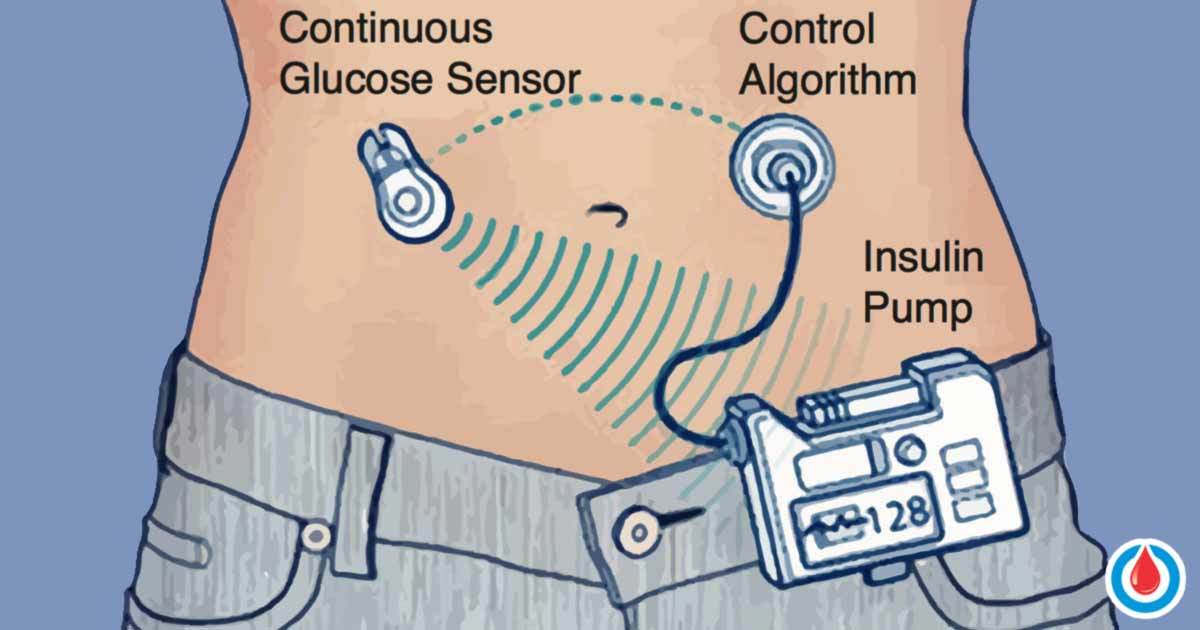 How a ClosedLoop Insulin Delivery Handles Unannounced