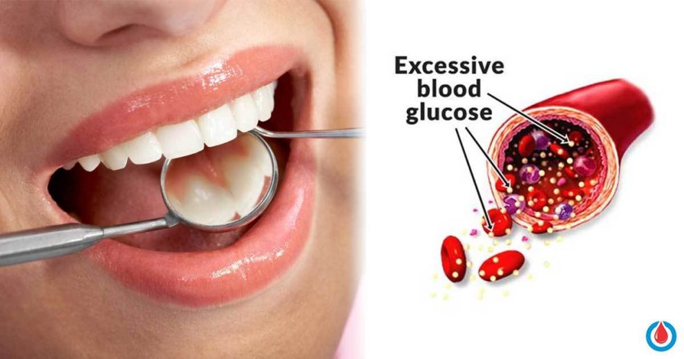 How Diabetes Affects Your Teeth and Useful Tips to Protect Them