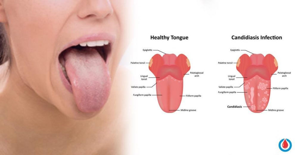 How to Recognize, Avoid and Treat Oral Thrush