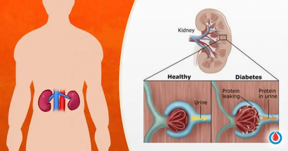 How High Blood Sugar Affects Your Kidneys 1