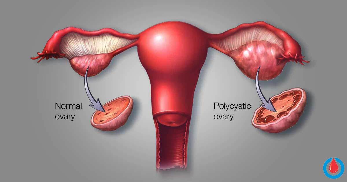 Polycystic Ovarian Disease in Rural Areas - includes a 