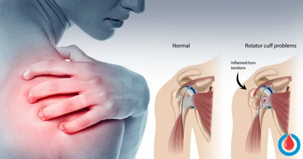 What is a ‘Frozen Shoulder’ and How to Treat It