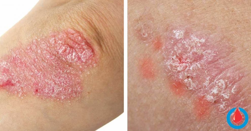 Is There a Connection Between Psoriasis and Diabetes