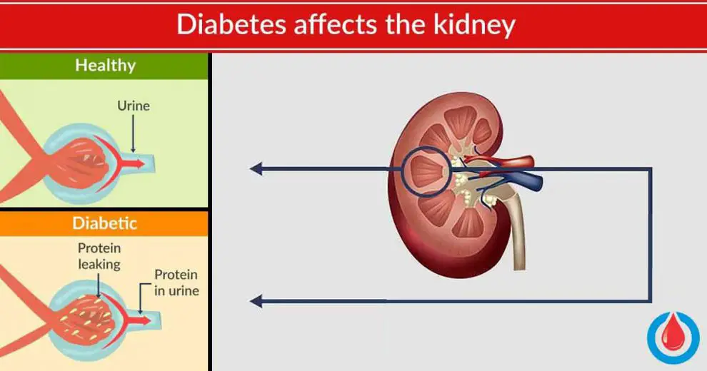 Here's How to Protect Your Kidneys If You Have Diabetes