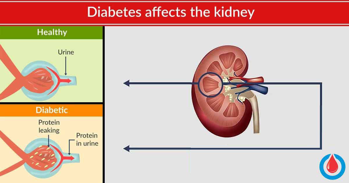 Here's How to Protect The Kidneys | Diabetes Health Page