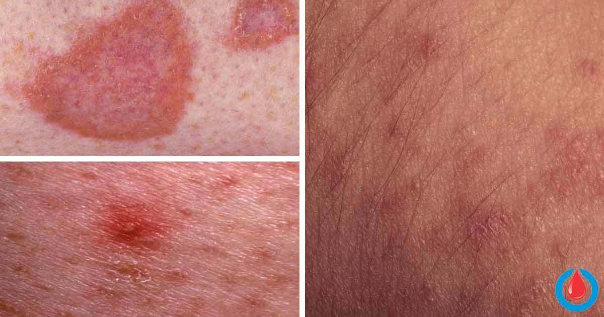 The Most Common Skin Complications Linked To Diabetes Diabetes Health 5101