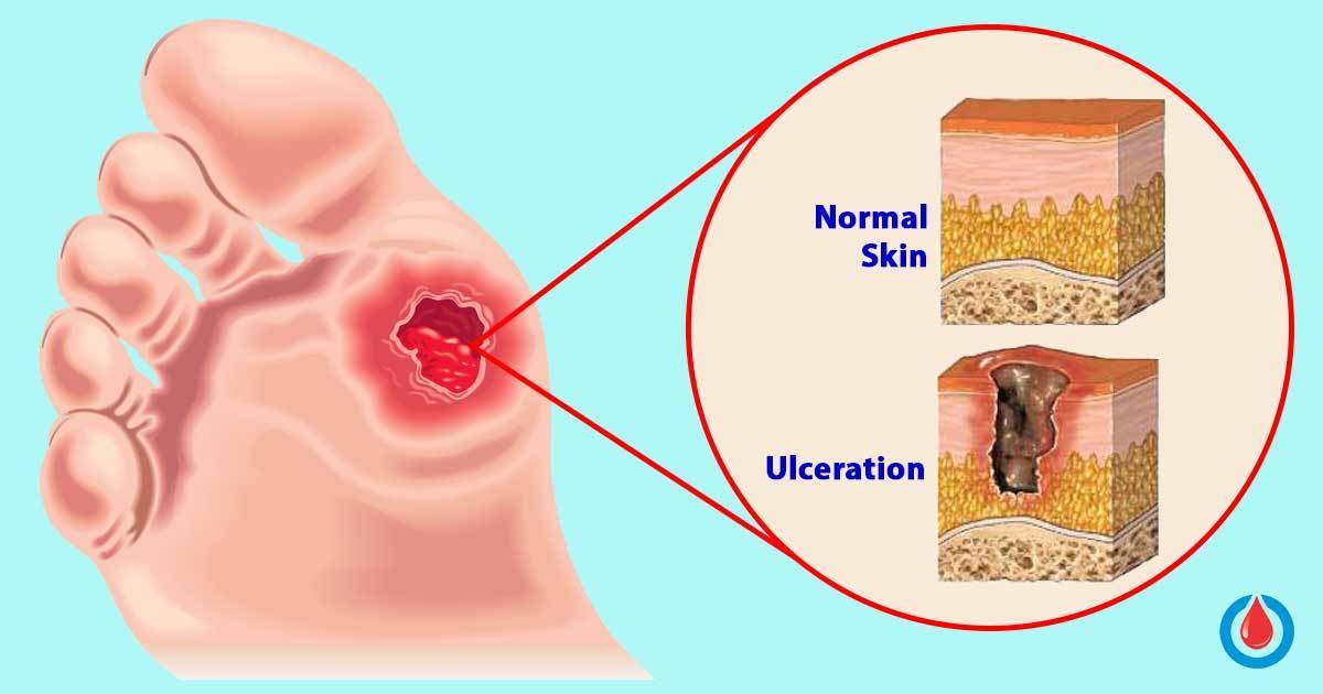 Diabetic Foot Ulcers Symptoms, Causes, and Treatment