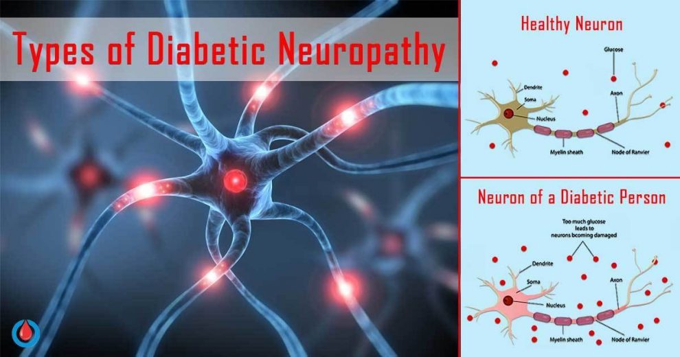 How To Recognize The 4 Types Of Diabetic Neuropathy Diabetes Health Page