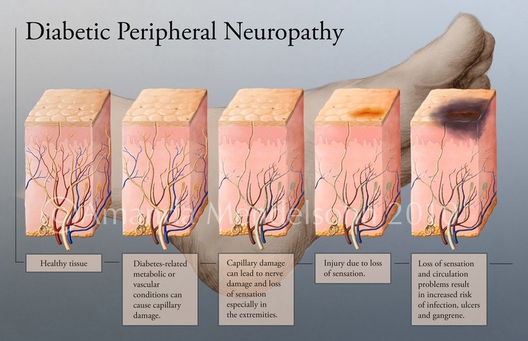 How to Recognize the 4 Types of Diabetic Neuropathy - Diabetes Health Page