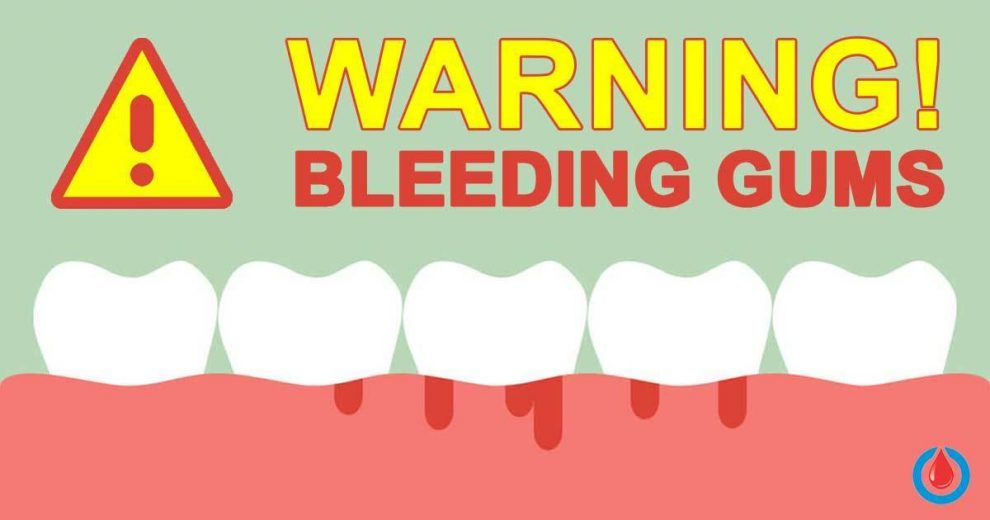 Could Bleeding Gums Be a Warning Sign of Diabetes