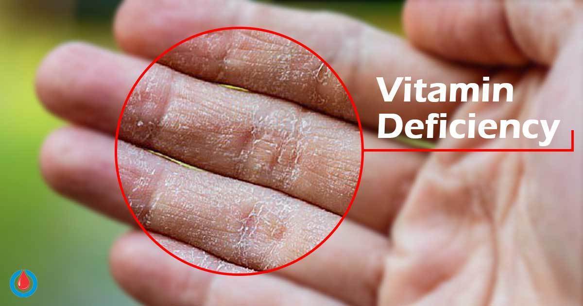 How Does Lack Of Vitamin A Affect Blood Sugar Levels Diabetes Health Page