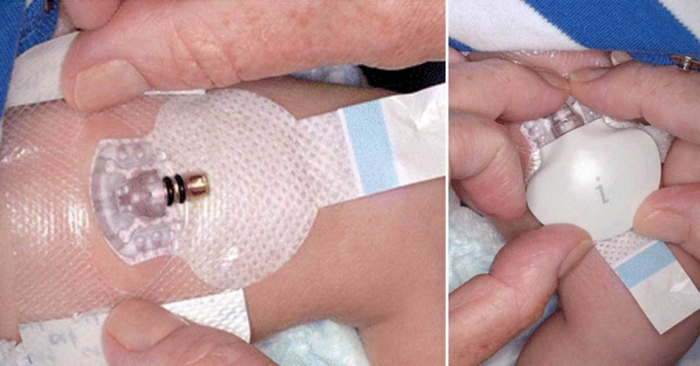 is-continuous-glucose-monitoring-in-newborn-babies-possible-in-near-future