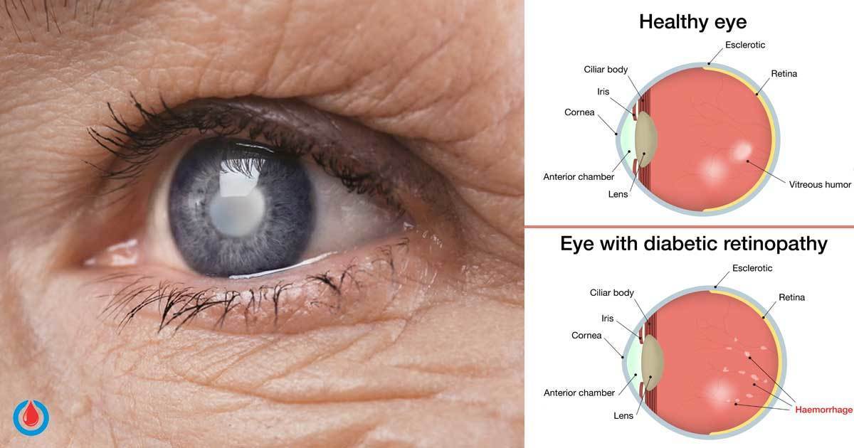 Prolonged High Blood Glucose Can Lead to Serious Eye Disease Diabetes