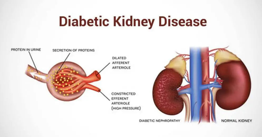 Diabetic Kidney Disease - Signs, Risk Factors and How to Prevent It