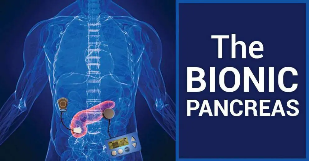 The Progress Toward a Bionic Pancreas for Type 1 Diabetes